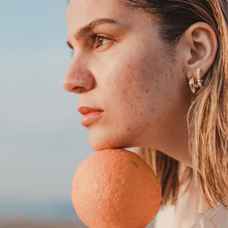 Atsisveikink su spuogais: išsamus gidas apie aknę, inkštirus ir komedonus